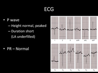 ECG
• P wave
– Height normal, peaked
– Duration short
(LA underfilled)
• PR – Normal
 