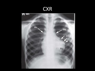 CXR
 