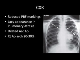 CXR
• Reduced PBF markings
• Lacy appearance in
Pulmonary Atresia
• Dilated Asc Ao
• Rt Ao arch 20-30%
 
