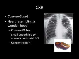 CXR
• Coer-en-Sabot
• Heart resembling a
wooden boot
– Concave PA bay
– Small underfilled LV
above a horizontal IVS
– Concentric RVH
 
