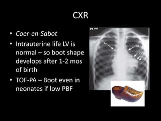 CXR
• Coer-en-Sabot
• Intrauterine life LV is
normal – so boot shape
develops after 1-2 mos
of birth
• TOF-PA – Boot even in
neonates if low PBF
 