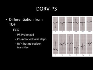 DORV-PS
• Differentiation from
TOF
- ECG
- PR Prolonged
- Counterclockwise depn
- RVH but no sudden
transition
 