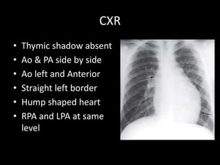 CXR
• Thymic shadow absent
• Ao & PA side by side
• Ao left and Anterior
• Straight left border
• Hump shaped heart
• RPA and LPA at same
level
 