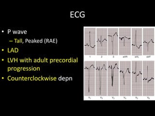 ECG
• P wave
– Tall, Peaked (RAE)
• LAD
• LVH with adult precordial
progression
• Counterclockwise depn
 