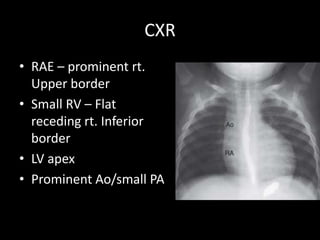 CXR
• RAE – prominent rt.
Upper border
• Small RV – Flat
receding rt. Inferior
border
• LV apex
• Prominent Ao/small PA
 