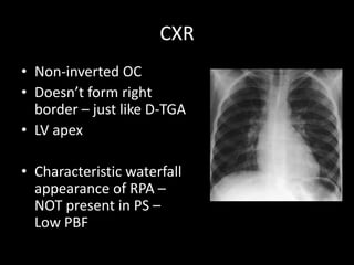 CXR
• Non-inverted OC
• Doesn’t form left
border – just like D-TGA
• LV apex
• Characteristic waterfall
appearance of RPA –
NOT present in PS –
Low PBF
 