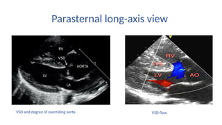 TOF echocardiographic Asssessment seminar PPTX