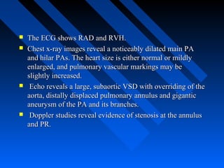  The ECG shows RAD and RVH.The ECG shows RAD and RVH.
 Chest x-ray images reveal a noticeably dilated main PAChest x-ray images reveal a noticeably dilated main PA
and hilar PAs. The heart size is either normal or mildlyand hilar PAs. The heart size is either normal or mildly
enlarged, and pulmonary vascular markings may beenlarged, and pulmonary vascular markings may be
slightly increased.slightly increased.
 Echo reveals a large, subaortic VSD with overriding of theEcho reveals a large, subaortic VSD with overriding of the
aorta, distally displaced pulmonary annulus and giganticaorta, distally displaced pulmonary annulus and gigantic
aneurysm of the PA and its branches.aneurysm of the PA and its branches.
 Doppler studies reveal evidence of stenosis at the annulusDoppler studies reveal evidence of stenosis at the annulus
and PR.and PR.
 