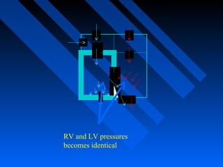 RV and LV pressures
becomes identical
 