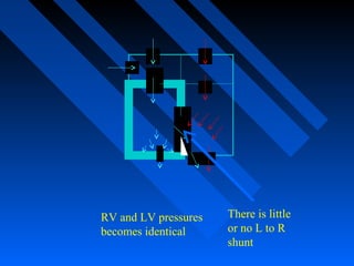 RV and LV pressures
becomes identical
There is little
or no L to R
shunt
 