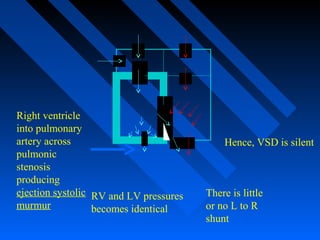 RV and LV pressures
becomes identical
There is little
or no L to R
shunt
Hence, VSD is silent
Right ventricle
into pulmonary
artery across
pulmonic
stenosis
producing
ejection systolic
murmur
 