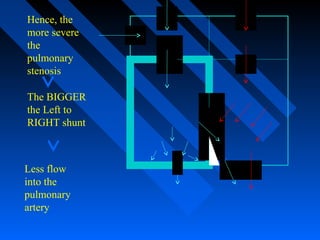 Hence, the
more severe
the
pulmonary
stenosis
The BIGGER
the Left to
RIGHT shunt
Less flow
into the
pulmonary
artery
 
