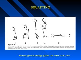 SQUATTING
Postural effects in tetralogy of fallot .Am J Med 15:297,1953
 