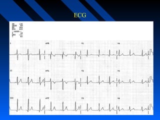 ECG
 ECGECG
 