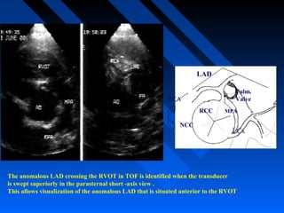 LAD
RCC
NCC
RCA
LCx
Pulm.
Valve
MPA
The anomalous LAD crossing the RVOT in TOF is identified when the transducer
is swept superiorly in the parasternal short -axis view .
This allows visualization of the anomalous LAD that is situated anterior to the RVOT
 