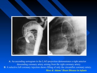 Moss & Adams' Heart Disease in infants
A: An ascending aortogram in the LAO projection demonstrates a right anterior
descending coronary artery arising from the right coronary artery.
B: A selective left coronary injection shows filling of only the circumflex coronary artery.
 