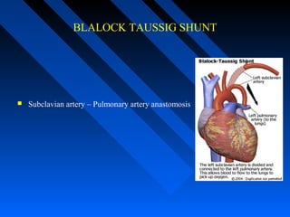BLALOCK TAUSSIG SHUNT
 Subclavian artery – Pulmonary artery anastomosis
 