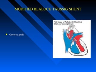 MODIFIED BLALOCK TAUSSIG SHUNT
 Goretex graft
 