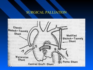 SURGICAL PALLIATION
 
