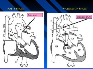 POTTS SHUNT WATERSTON SHUNT
 