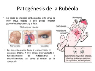 Patogénesis de la Rubéola
• En casos de mujeres embarazadas, este virus es
muy grave debido a que puede infectar
gravemente la placenta y al feto.
• Las infección puede llevar a teratogénesis, en
cualquier órgano. A nivel celular el virus afecta el
de mitocondrias y
así como el control de la
funcionamiento
microfilamentos,
apoptosis.
 