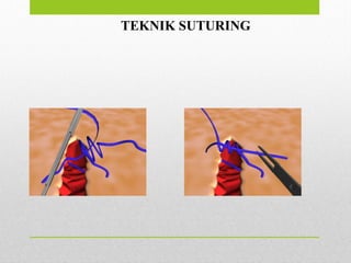 TEKNIK SUTURING
 