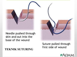 TEKNIK SUTURING
 