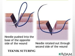 TEKNIK SUTURING
 