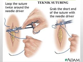 TEKNIK SUTURING
 
