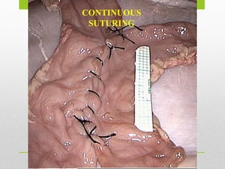 CONTINUOUS
SUTURING
 