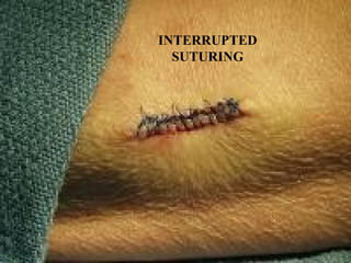 INTERRUPTED
SUTURING
 