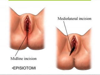 •EPISIOTOMI
 