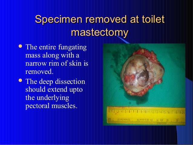 toilet mastectomy