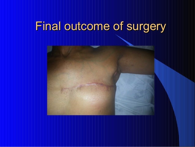 toilet mastectomy