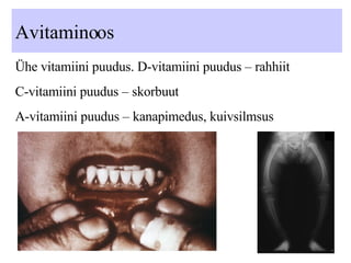 Avitaminoos Ühe vitamiini puudus. D-vitamiini puudus – rahhiit  C-vitamiini puudus – skorbuut A-vitamiini puudus – kanapimedus, kuivsilmsus 