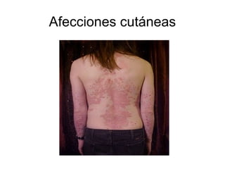 Afecciones cutáneas
 