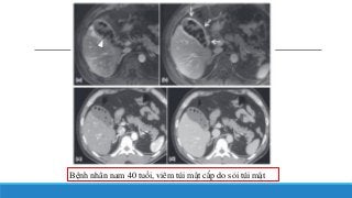 Bệnh nhân nam 40 tuổi, viêm túi mật cấp do sỏi túi mật
 