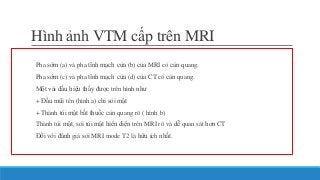 Hình ảnh VTM cấp trên MRI
Pha sớm (a) và pha tĩnh mạch cửa (b) của MRI có cản quang.
Pha sớm (c) và pha tĩnh mạch cửa (d) của CT có cản quang.
Một vài dấu hiệu thấy được trên hình như
+ Đầu mũi tên (hình a) chỉ sỏi mật
+ Thành túi mật bắt thuốc cản quang rõ ( hình b)
Thành túi mật, sỏi túi mật hiển diện trên MRI rõ và dễ quan sát hơn CT
Đối với đánh giá sỏi MRI mode T2 là hữu ích nhất.
 