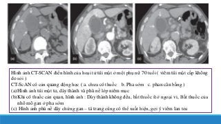 Hình ảnh CT-SCAN điển hình của hoại tử túi mật ở một phụ nữ 70 tuổi ( viêm túi mật cấp không
do sỏi )
CT-ScAN có cản quang động học ( a. chưa có thuốc b. Pha sớm c. phan cân bằng )
(a)Hình ảnh túi mật to, dày thành và phù nề lớp niêm mạc
(b)Khi có thuốc cản quan, hình ảnh : Dày thành không đều, bắt thuốc ít ở ngoại vi, Bắt thuốc của
nhô mô gan ở pha sớm
(c) Hình ảnh phù nề dây chừng gan – tá trang cũng có thể xuất hiện, gợi ý viêm lan tỏa
 