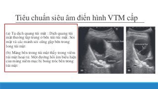 Tiêu chuẩn siêu âm điển hình VTM cấp
(a) Tụ dịch quang túi mật : Dịch quang túi
mật thường tập trung ở bên trái túi mật. Sỏi
mật và các mảnh sỏi cũng gặp bên trong
long túi mật
(b) Màng bên trong túi mật thấy trong viêm
túi mật hoại tử. Một đường hồi âm biểu hiện
của màng niêm mạc bị bong tróc bên trong
túi mật
 
