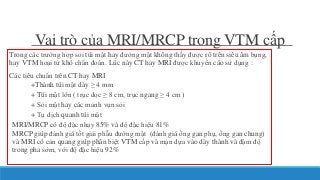 Trong các trường hợp sỏi túi mật hay đường mật không thấy được rõ trên siêu âm bụng,
hay VTM hoại tử khó chẩn đoán. Lúc này CT hay MRI được khuyến cáo sử dụng :
Các tiêu chuẩn trên CT hay MRI
+Thành túi mật dày ≥ 4 mm
+ Túi mật lớn ( trục dọc ≥ 8 cm, trục ngang ≥ 4 cm )
+ Sỏi mật hay các mảnh vụn sỏi
+ Tụ dịch quanh túi mật
MRI/MRCP có độ đặc nhạy 85% và độ đặc hiệu 81%
MRCP giúp đánh giá tốt giải phẫu đường mật (đánh giá ống gan phụ, ống gan chung)
và MRI có cản quang giúp phân biệt VTM cấp và mạn dựa vào dày thành và đậm độ
trong pha sớm, với độ đặc hiệu 92%
Vai trò của MRI/MRCP trong VTM cấp
 