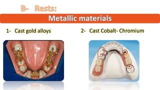 "
“ ”
1- Cast gold alloys 2- Cast Cobalt- Chromium
 