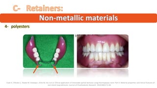 “4- “polyesters ”
“ ”
“ Fueki K, Ohkubo C, Yatabe M, Arakawa I, Arita M, Ino S et al. Clinical application of removable partial dentures using thermoplastic resin. Part II: Material properties and clinical features of
non-metal clasp dentures. Journal of Prosthodontic Research. 2014;58(2):71-84.”
 