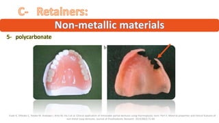“5- “polycarbonate ”
“ ”
“ Fueki K, Ohkubo C, Yatabe M, Arakawa I, Arita M, Ino S et al. Clinical application of removable partial dentures using thermoplastic resin. Part II: Material properties and clinical features of
non-metal clasp dentures. Journal of Prosthodontic Research. 2014;58(2):71-84.”
 