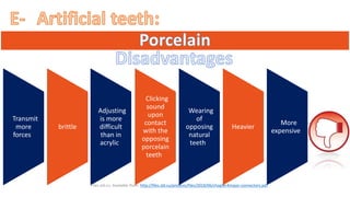 “ ”
“Transmit
more
forces”
“brittle”
“Adjusting
is more
difficult
than in
acrylic”
“Clicking
sound
upon
contact
with the
opposing
porcelain
teeth”
“Wearing
of
opposing
natural
teeth”
“Heavier”
“More
expensive”
“Files.sld.cu. Available from: http://files.sld.cu/protesis/files/2018/06/chapter4major-connectors.pdf”
 