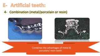 “ ”
4- “Combination (metal/porcelain or resin)
“Combines the advantages of metal &
porcelain/ resin teeth”
 