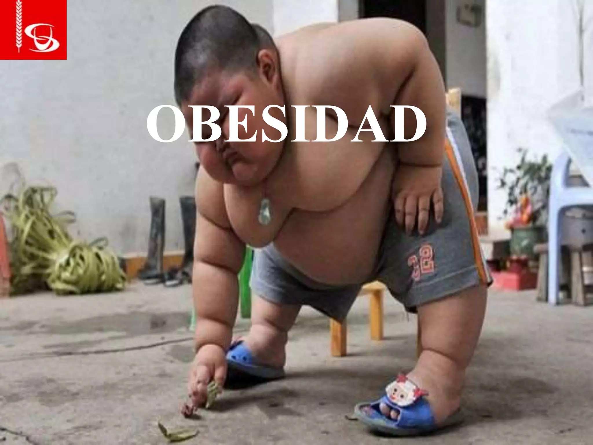 OBESIDAD
 