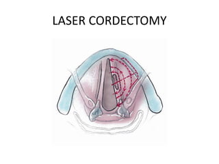 Cordectomy LASER IN ENT | PPTX