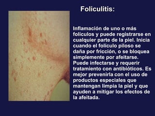 Inflamación de uno o más folículos y puede registrarse en cualquier parte de la piel. Inicia cuando el folículo piloso se daña por fricción, o se bloquea simplemente por afeitarse. Puede infectarse y requerir tratamiento con antibióticos. Es mejor prevenirla   con el uso de productos especiales que mantengan limpia la piel y que ayuden a mitigar los efectos de la afeitada.   Foliculitis: 