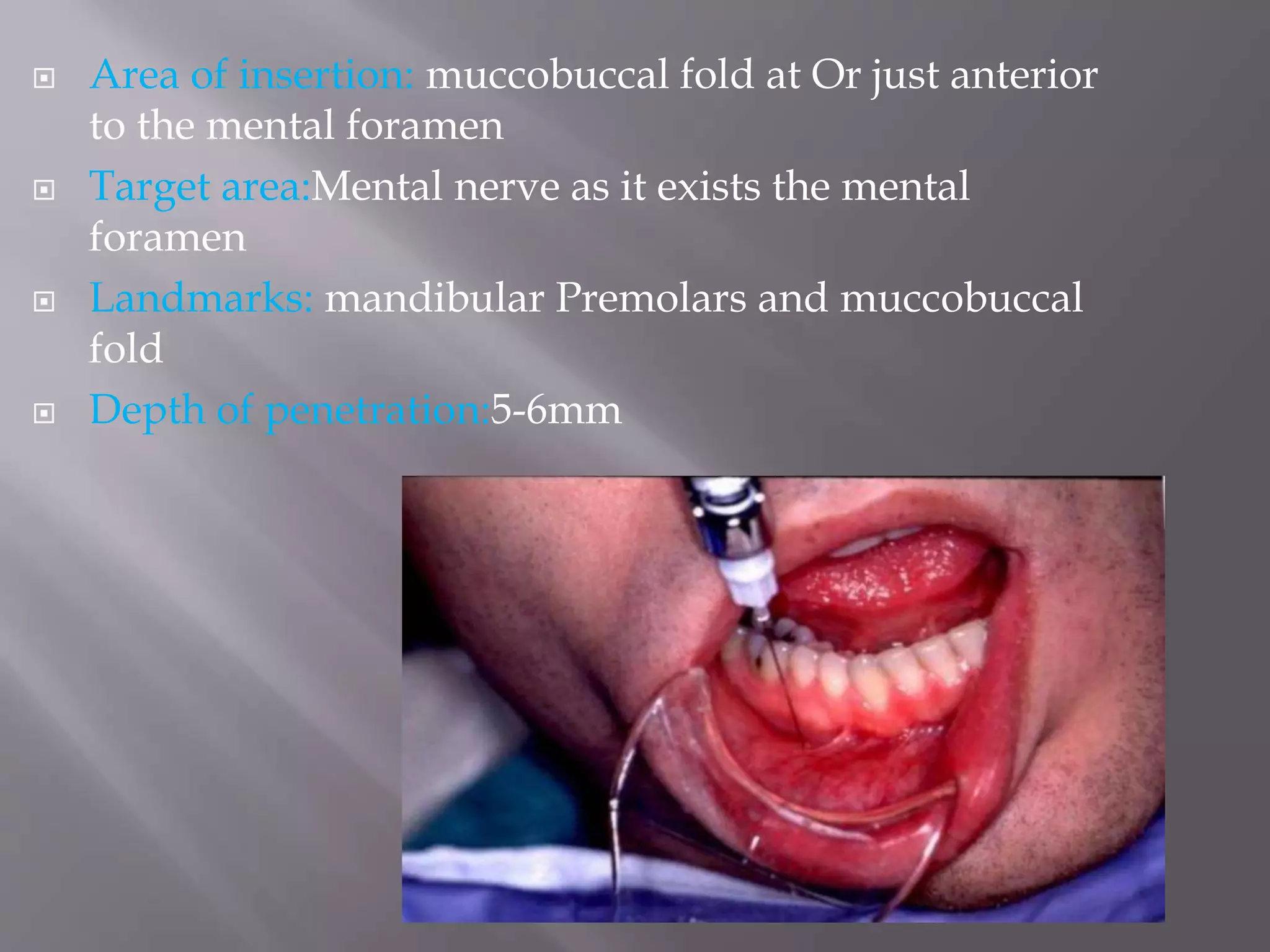 Mandibular injection techniques | PPTX
